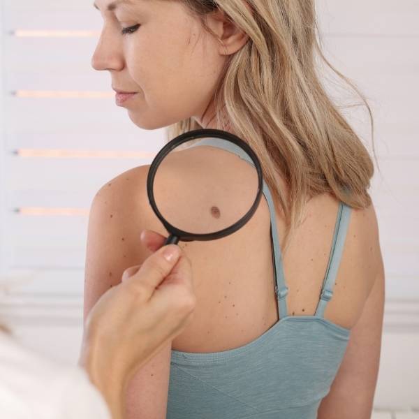 Cuidado de la piel: Guía para el autoexamen y control de lunares