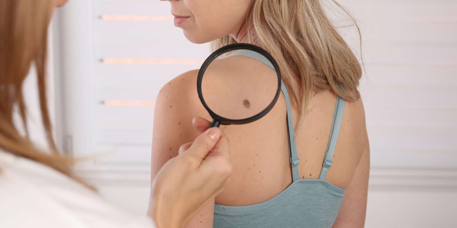 Cuidado de la piel: La importancia vital del chequeo dermatológico de lunares