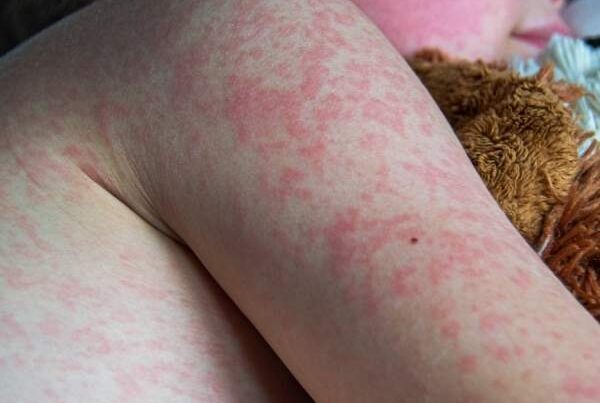 Sarampión: ¿Qué es, síntomas, contagio y cómo prevenirlo?